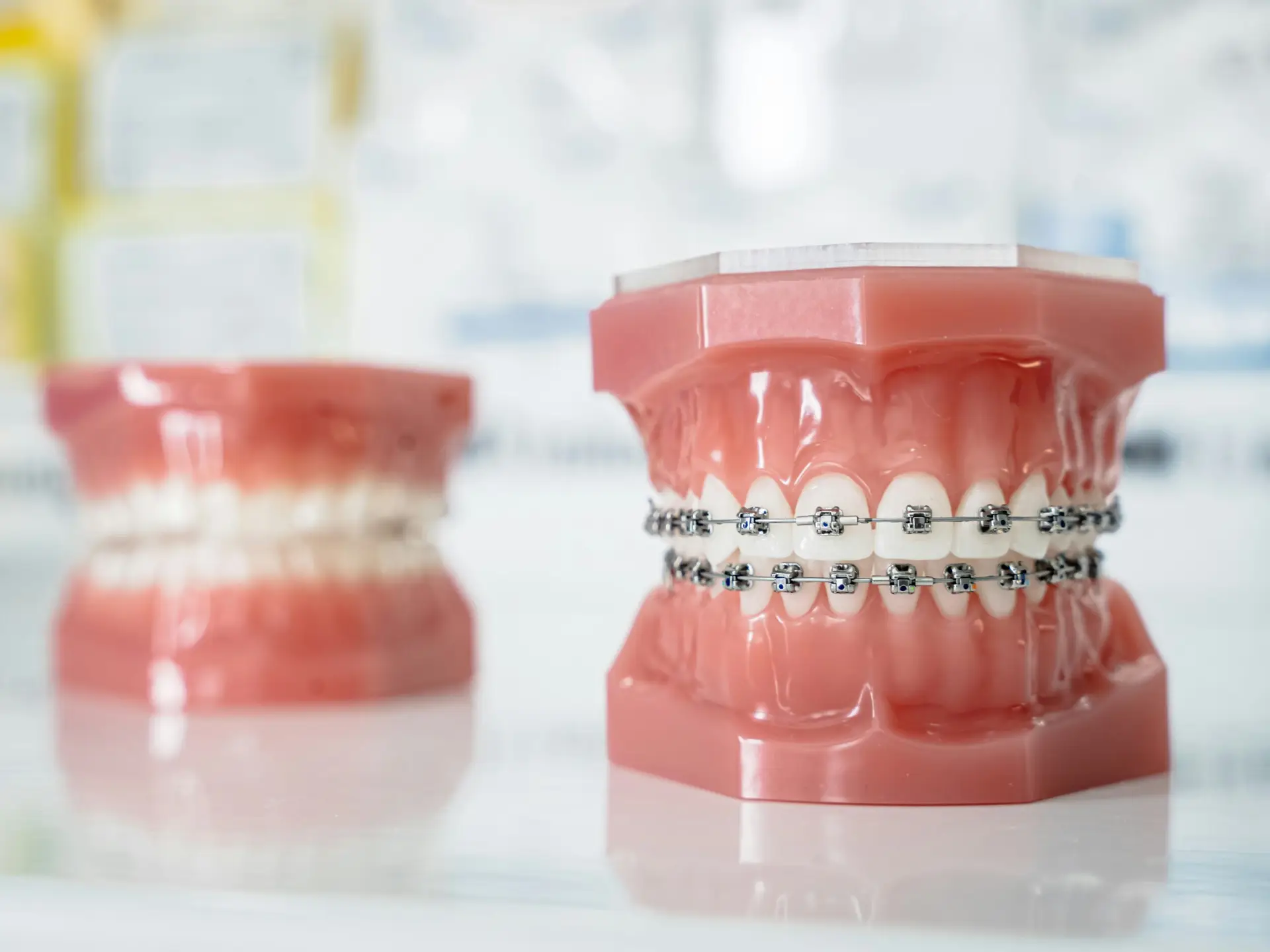Model of traditional metal braces demonstrating orthodontic treatment used to correct tooth alignment and bite issues.